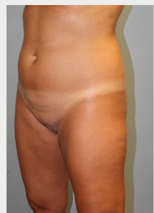 Before Image: Smart Lipo – Dr. Tucker - left-front-oblique
