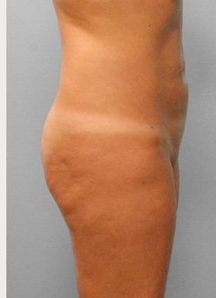 After Image: Smart Lipo – Dr. Tucker - right-side