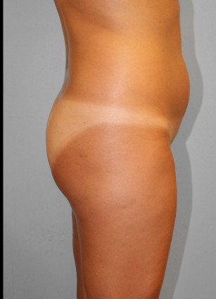 Before Image: Smart Lipo – Dr. Tucker - right-side