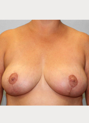 After Image: Breast Reduction – Dr. Howell - front