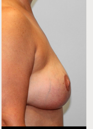 After Image: Breast Reduction – Dr. Howell - right-side