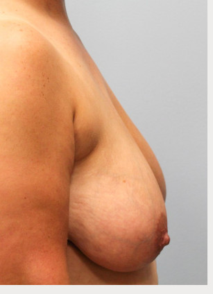 Before Image: Breast Reduction – Dr. Howell - right-side