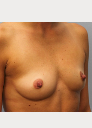 Before Image: Breast Augmentation – Dr. Howell - right-front-oblique