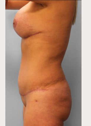 After Image: Mommy Makeover – Dr. Howell - other