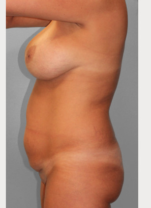 Before Image: Mommy Makeover – Dr. Howell - other