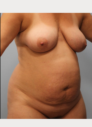 Before Image: Smart Lipo – Dr. Howell - other