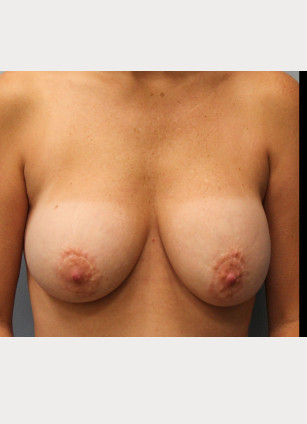 Before Image: Breast Augmentation Revision & Mastopexy – Dr. Tucker - front