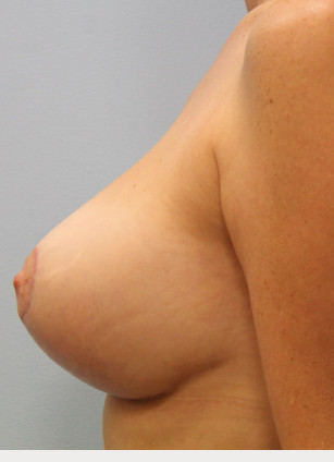 After Image: Breast Augmentation Revision & Mastopexy – Dr. Tucker - left-side