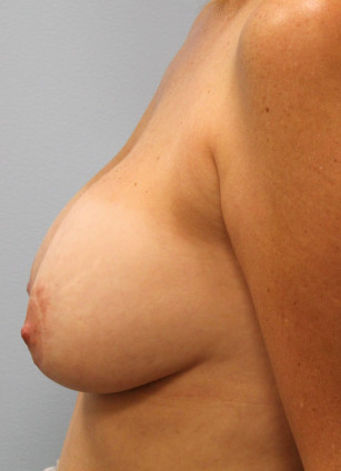 Before Image: Breast Augmentation Revision & Mastopexy – Dr. Tucker - left-side