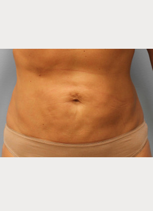 After Image: Smart Lipo – Dr. Tucker - front