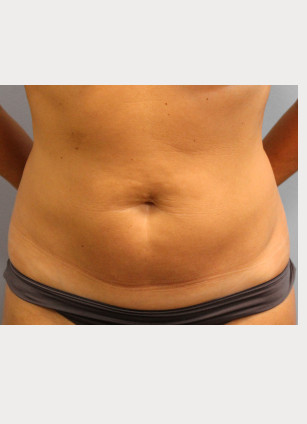 Before Image: Smart Lipo – Dr. Tucker - front
