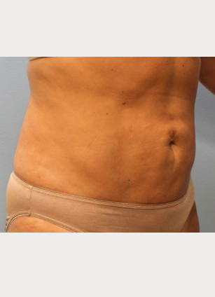 After Image: Smart Lipo – Dr. Tucker - right-front-oblique