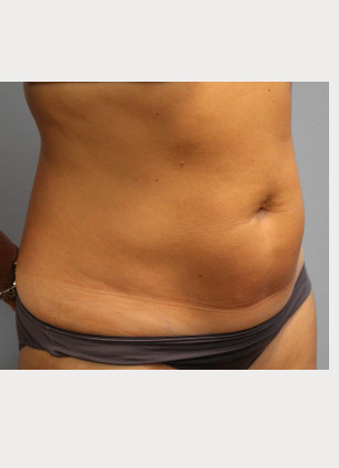 Before Image: Smart Lipo – Dr. Tucker - right-front-oblique