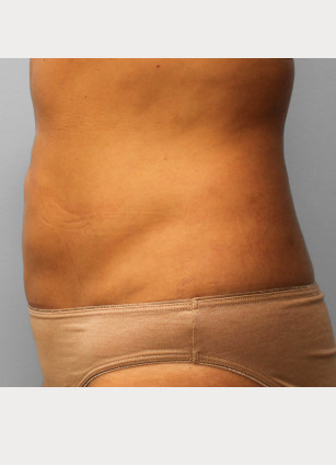After Image: Smart Lipo – Dr. Tucker - left-side