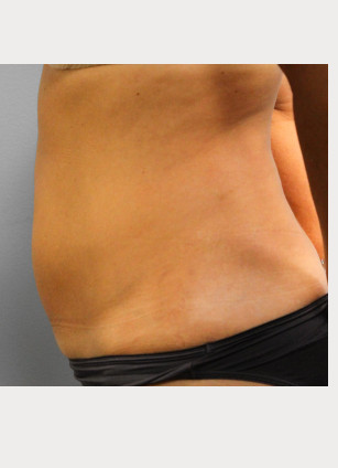 Before Image: Smart Lipo – Dr. Tucker - left-side