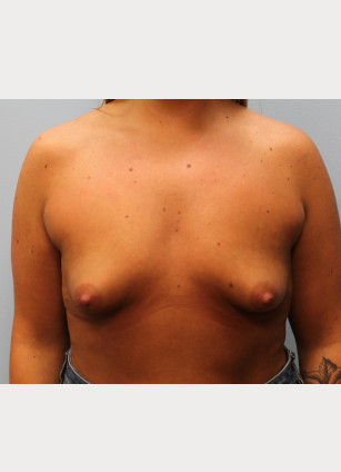 Before Image: Breast Augmentation – Dr. Tucker - front