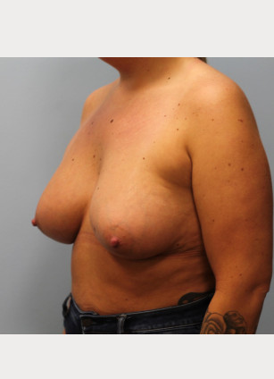 After Image: Breast Augmentation – Dr. Tucker - other