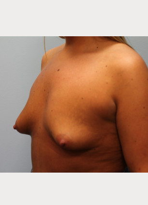 Before Image: Breast Augmentation – Dr. Tucker - other
