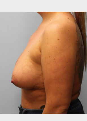 After Image: Breast Augmentation – Dr. Tucker - other