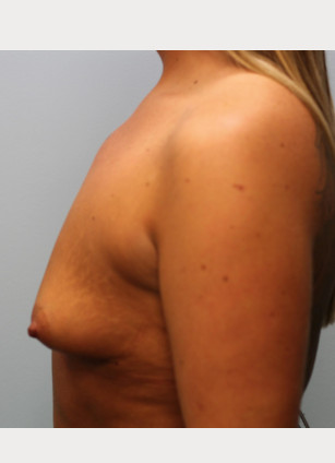 Before Image: Breast Augmentation – Dr. Tucker - other