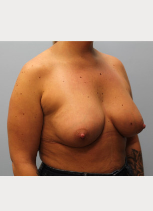 After Image: Breast Augmentation – Dr. Tucker - other
