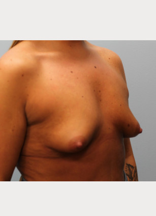 Before Image: Breast Augmentation – Dr. Tucker - other