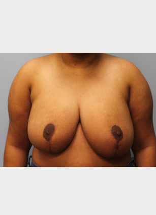 After Image: Breast Reduction – Dr. Tucker - front