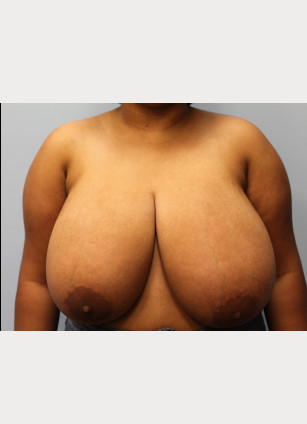 Before Image: Breast Reduction – Dr. Tucker - front