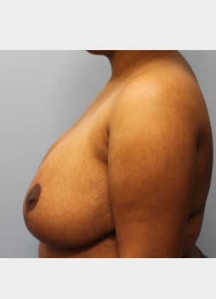 After Image: Breast Reduction – Dr. Tucker - other