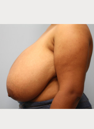 Before Image: Breast Reduction – Dr. Tucker - other