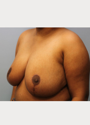 After Image: Breast Reduction – Dr. Tucker - other