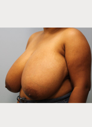 Before Image: Breast Reduction – Dr. Tucker - other