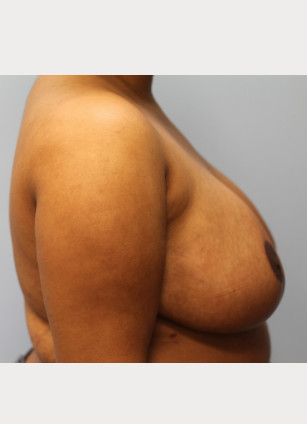 After Image: Breast Reduction – Dr. Tucker - other