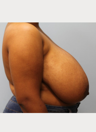 Before Image: Breast Reduction – Dr. Tucker - other