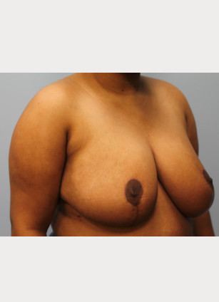 After Image: Breast Reduction – Dr. Tucker - other