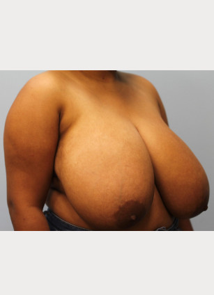 Before Image: Breast Reduction – Dr. Tucker - other