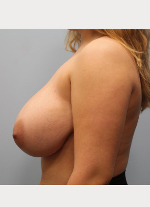 Before Image: Breast Reduction – Dr. Tucker - other