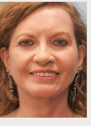 After Image: Facelift – Dr. Tucker - front