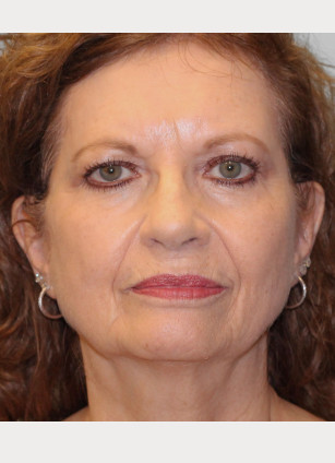 Before Image: Facelift – Dr. Tucker - front