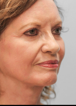 After Image: Facelift – Dr. Tucker - right-front-oblique