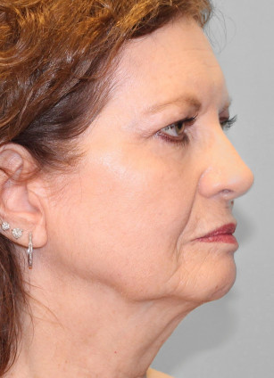 Before Image: Facelift – Dr. Tucker - right-front-oblique