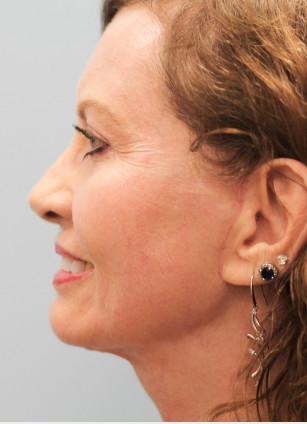 After Image: Facelift – Dr. Tucker - front