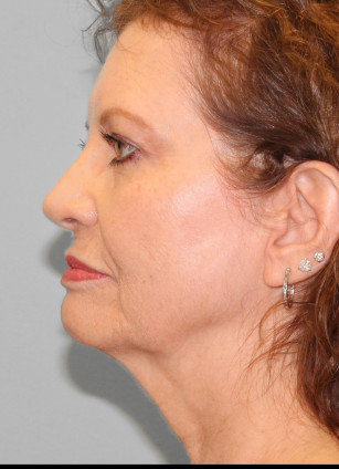 Before Image: Facelift – Dr. Tucker - front
