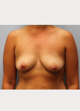Before Image: Breast Augmentation With Mastopexy (Lift) – Dr. Tucker - front