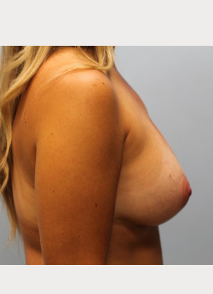 After Image: Breast Augmentation With Mastopexy (Lift) – Dr. Tucker - other