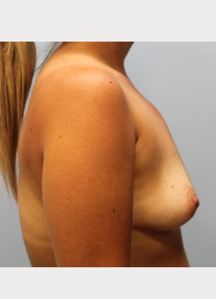 Before Image: Breast Augmentation With Mastopexy (Lift) – Dr. Tucker - other