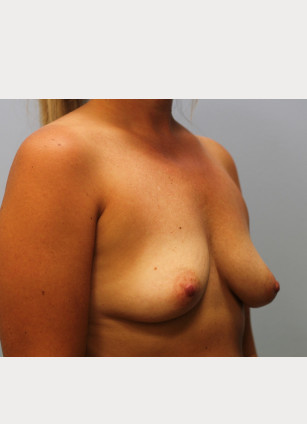 Before Image: Breast Augmentation With Mastopexy (Lift) – Dr. Tucker - other