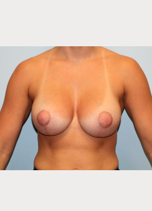 After Image: Breast Augmentation With Mastopexy (Lift) – Dr. Tucker - front