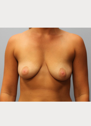 Before Image: Breast Augmentation With Mastopexy (Lift) – Dr. Tucker - front