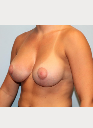 After Image: Breast Augmentation With Mastopexy (Lift) – Dr. Tucker - other